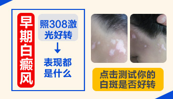 刚发现白癜风可以直接照激光吗