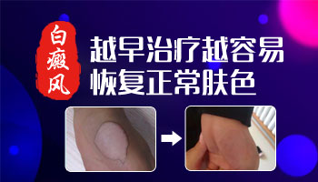 3个月宝宝身上有白斑应该怎么治疗