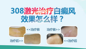 12岁小孩脸上有白斑用激光治疗好吗