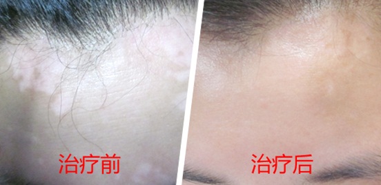 相约里约奥运会，白斑患者应该get到的几件事？