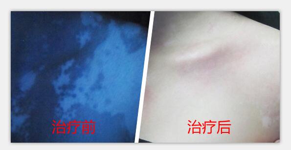 自体组织工程皮肤移植术