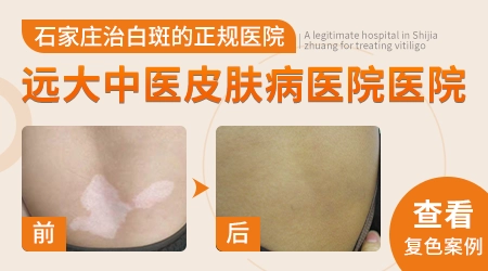 女性白斑早期症状图