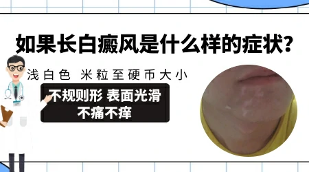 皮肤出白斑和之前皮肤过敏长湿疹有关系吗