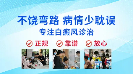 口服激素药治疗进展期白癜风要吃多久