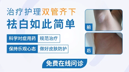 贫血痣和白癜风的白斑有什么不一样