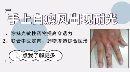 白癜风照窄谱uvb光产生耐光性怎么办