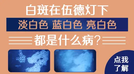 伍德灯下白斑发蓝白色荧光代表什么意思