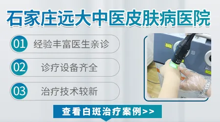 石家庄哪个医院皮肤科看白斑更专业