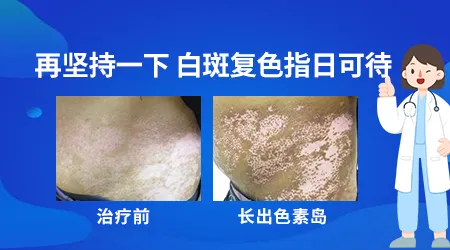 白癜风种植手术后长黑色素岛样子图片