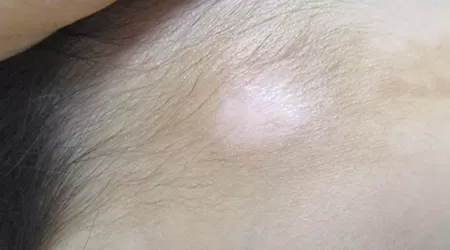 额头一块白照308激光能不能好