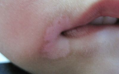 嘴角边有一小块皮肤泛白是什么