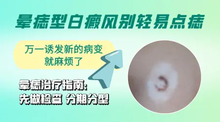 晕痣白癜风的治疗费用大概是多少