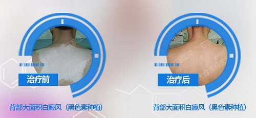 衡水治疗白癜风的方法哪一种好