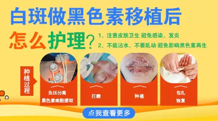 黑色素种植手术治白癜风费用高不高