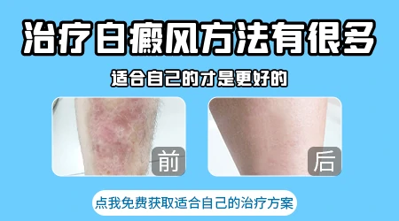 白癜风有没有快速消白斑又安全的方法