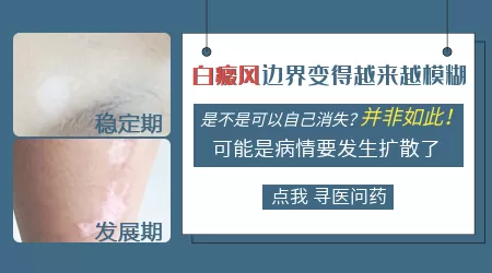 白斑边缘模糊是否一定代表病情处于活动期