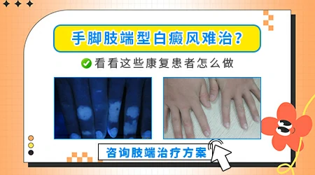 手脚肢端的白斑是不是真的很难治好
