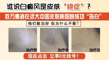 专业治身上白斑的医院