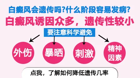 没有家族史为什么也会得白癜风