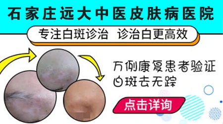 <a href=https://www.bdfcctv.com/sjzbdfyy/ target=_blank class=infotextkey>石家庄白癜风医院</a>有名气的是哪家