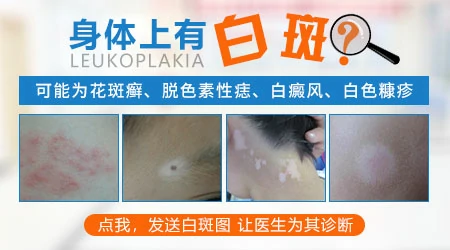 色素脱失白斑怎么能自愈