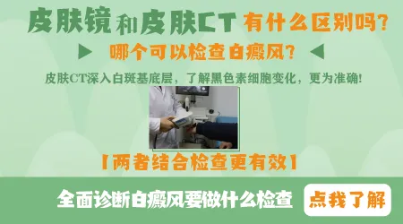 皮肤CT和皮肤镜哪个检查白斑更准确