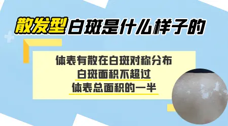 散发型白癜风还能治好吗