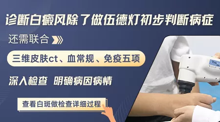 wood灯显示无荧光能排除是白癜风吗