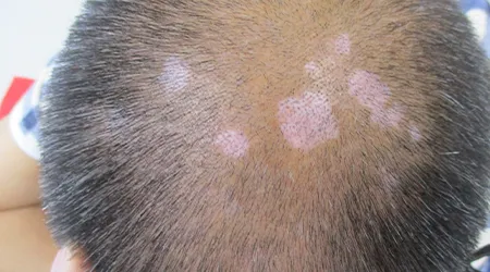 头皮上出现白斑是什么原因引起的