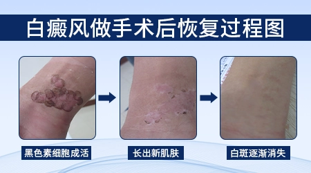 黑色素种植手术治白癜风费用高不高