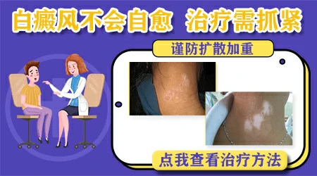 白斑会自己消失吗