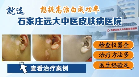 石家庄远大中医皮肤病医院哪个医生看白癜风好