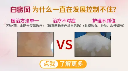 进展期白癜风患者是否适合手术
