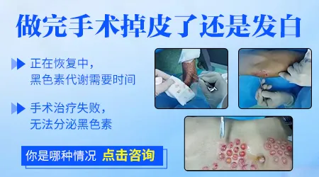 表皮移植半月后皮掉了还有白怎么办