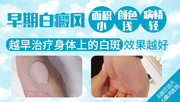 手指白癜风不好治好吗