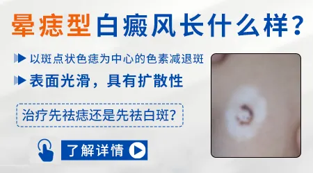 晕痣白癜风刚出现时症状图片