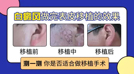 脸部白癜风做表皮移植手术后的效果图