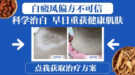 无花果汁真的能治白癜风吗