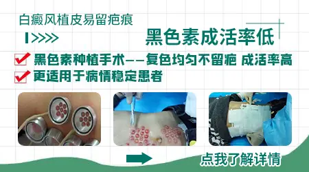 白癜风植皮后多久可以碰水