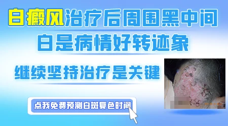 白癜风好转时会有什么变化