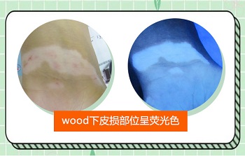 wood灯下的白癜风是什么颜色