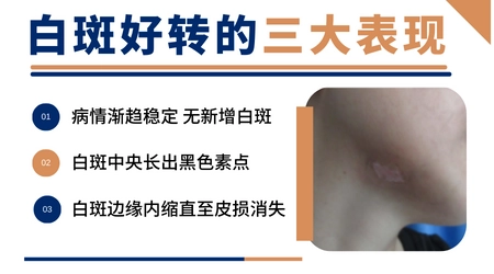 白癜风照308激光后有什么反应才算好转