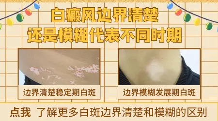 白斑边界模糊是白癜风早期吗