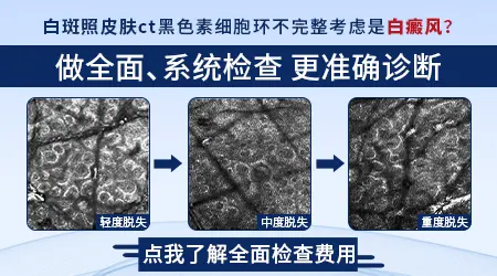 皮肤CT检查显示基底层黑素细胞减少一定是白癜风吗