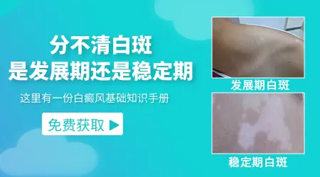 身上的白癜风稳定期有什么症状