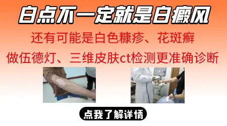 脖子上长了块浅白印会不会是白癜风