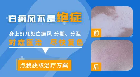 白癜风白斑越来越明显怎么办