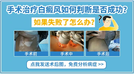 黑色素移植后皮掉后还是白色