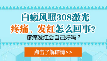 白癜风照射完激光后又红又疼有事吗