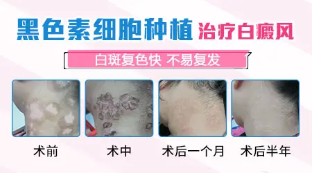 白斑手术后多久才能好
